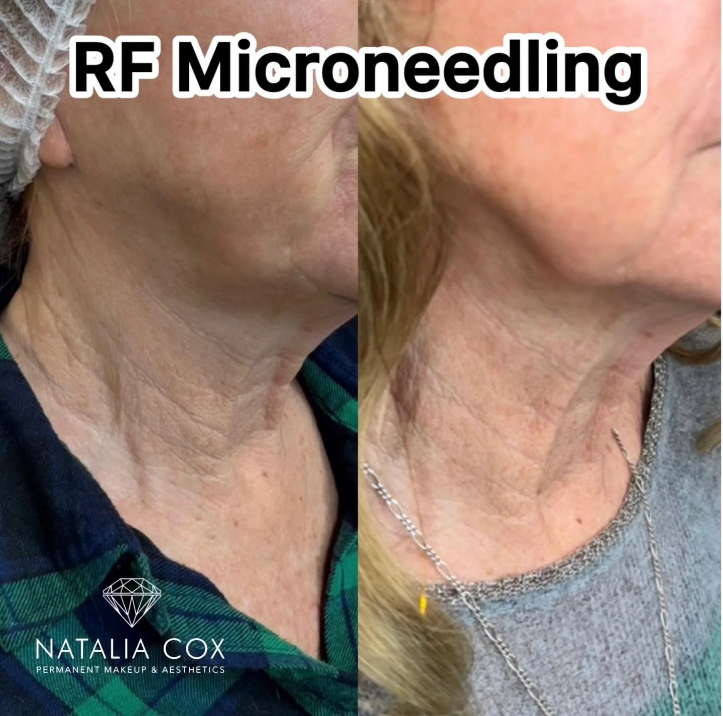 The neck&hellip; is one of the most challenging areas to treat, especially when signs of aging have already settled in. The skin here is very delicate, loses elasticity faster, and requires advanced treatments to achieve visible results.
Procedures l