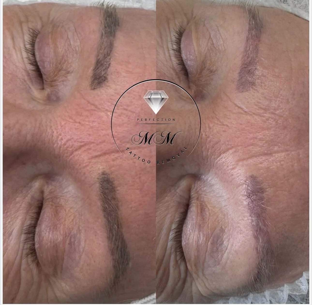 MM tattoo removal &ndash; before &amp; after ✨

Just one session in and still healing, but what a difference already! The pigment has lifted beautifully and we&rsquo;re on the right track for a much cleaner result. Can&rsquo;t wait to see the final o