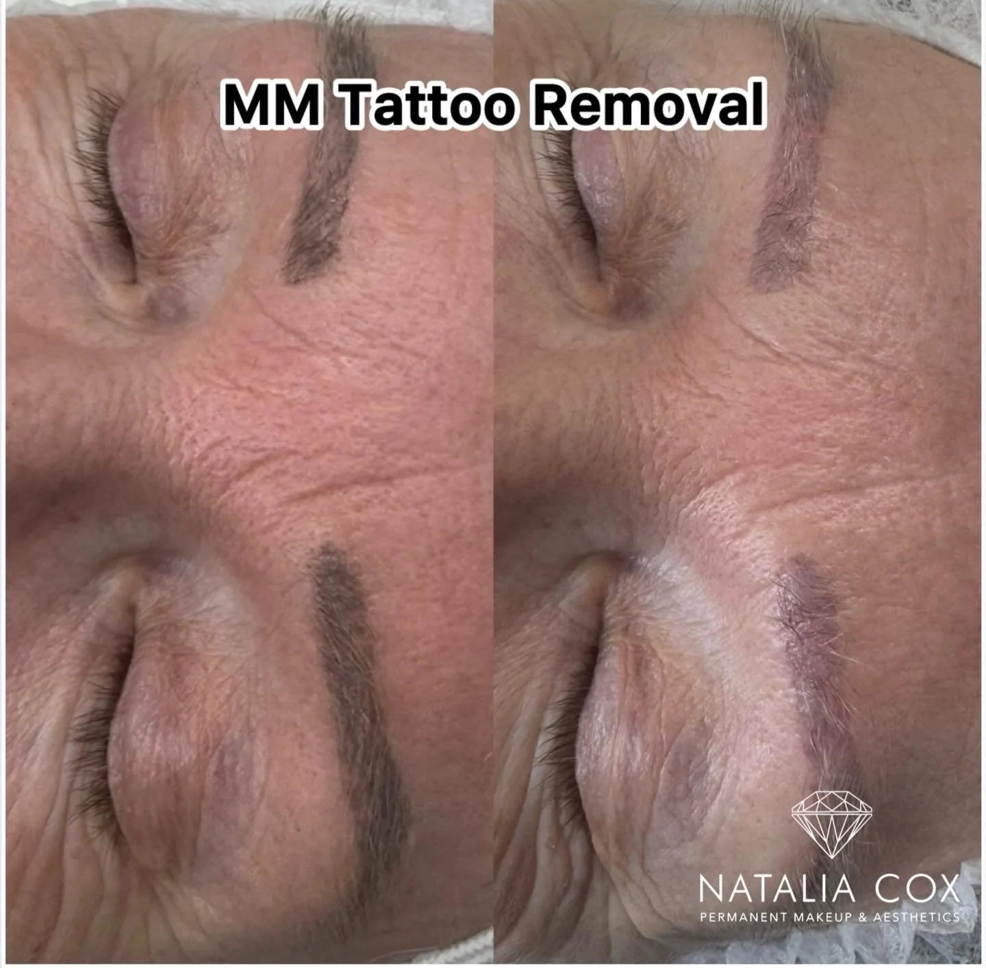 MM tattoo removal &ndash; before &amp; after ✨

Just one session in and still healing, but what a difference already! The pigment has lifted beautifully and we&rsquo;re on the right track for a much cleaner result. Can&rsquo;t wait to see the final o