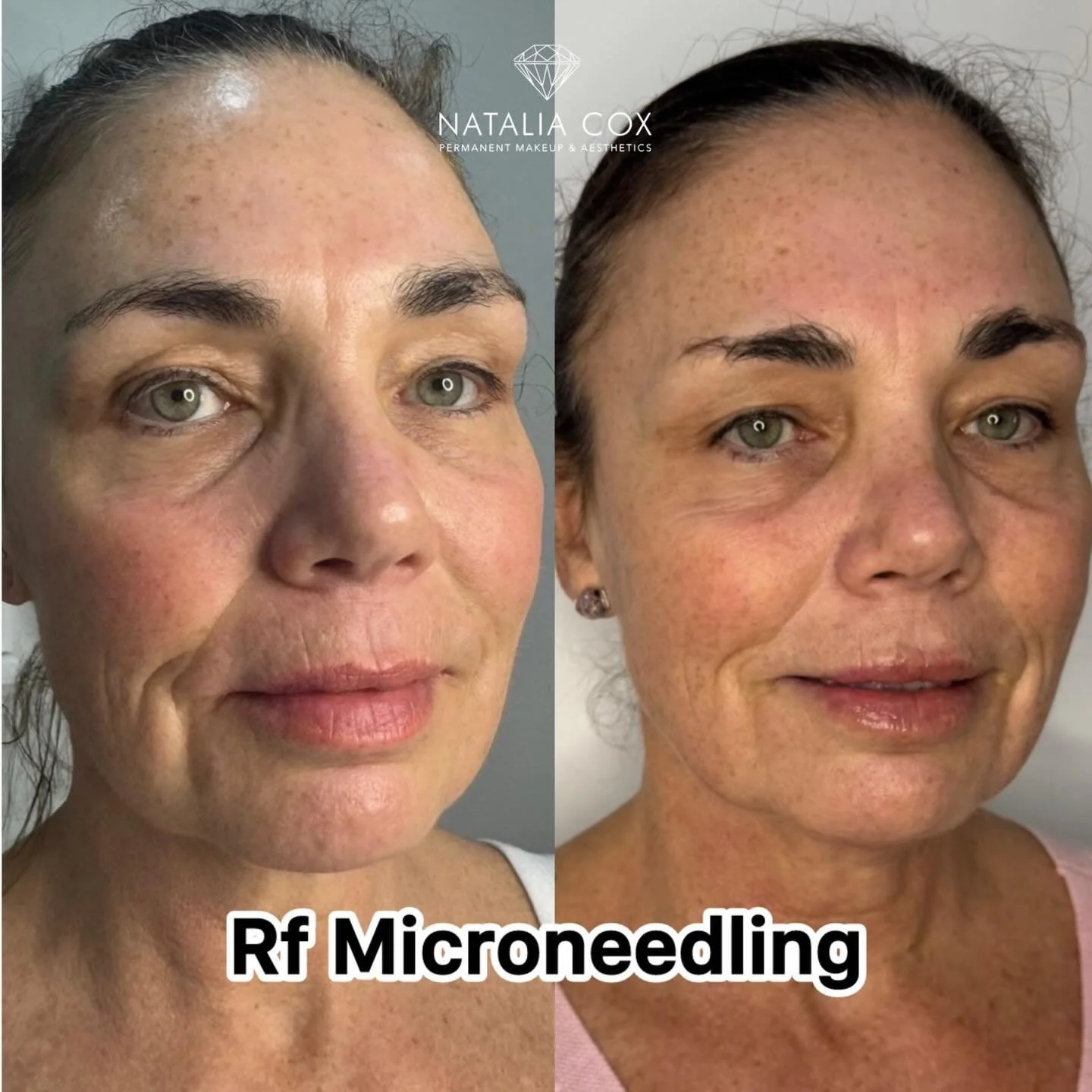 ✨ RF Microneedling Results ✨

Take a look at these incredible under-eye improvements 👀

This treatment has made a huge difference in:
✔️ Reducing under-eye bags and puffiness 
✔️ Smoothing fine lines and crepey skin 
✔️ Tightening and firming the de
