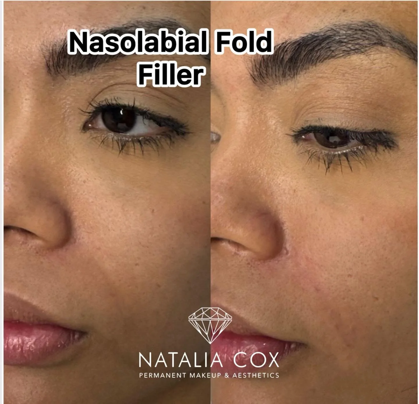 Nasolabial Fold Filler &ndash; Before &amp; After ✨
Subtle yet effective correction to soften the nasolabial folds and restore mid-face support.
Results show improved smoothness and a more refreshed, natural appearance without overfilling.

Immediate