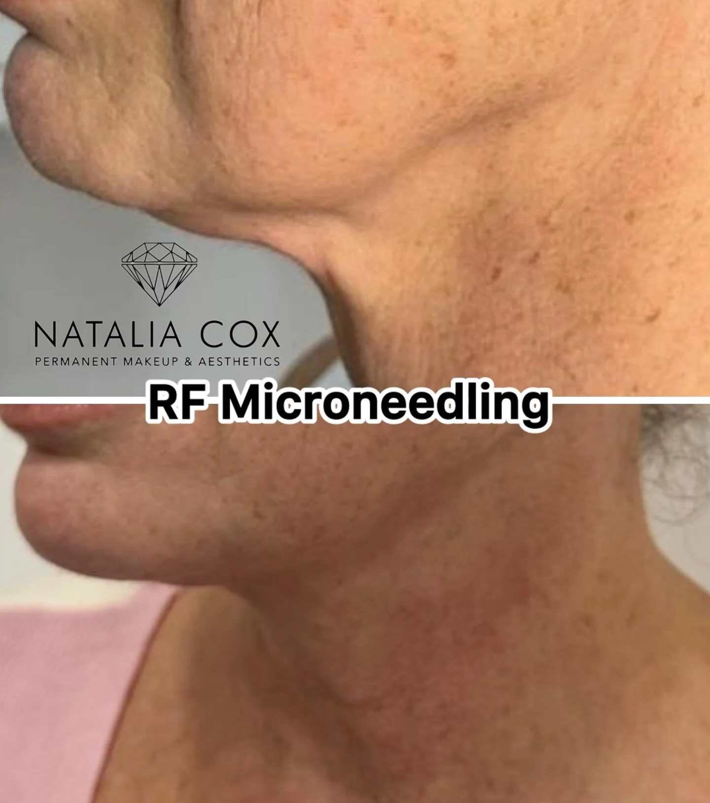 🌟 **The secret to a perfect jawline and a youthful neck!**

Have you noticed that the skin on your neck often gives away your age first, and the chin area loses its firmness over time? Creams don&rsquo;t always do the trick here, but modern cosmetol