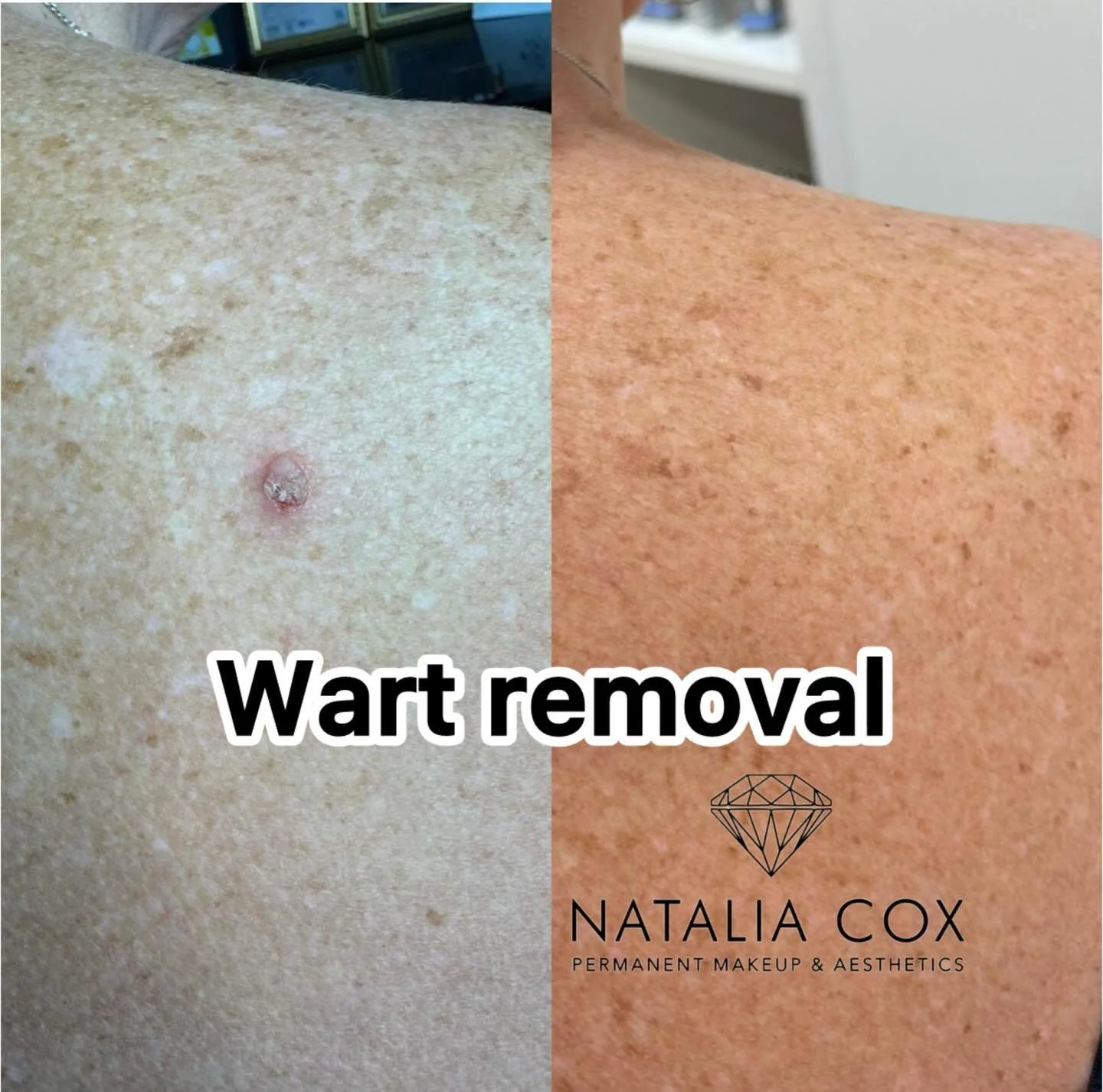 Warts are not just an aesthetic issue, but also a frequent cause of physical discomfort. There&rsquo;s no need to put up with them or try DIY removal methods, as that can be unsafe! 🙅&zwj;♀️

At our clinic, the removal procedure is performed to the 