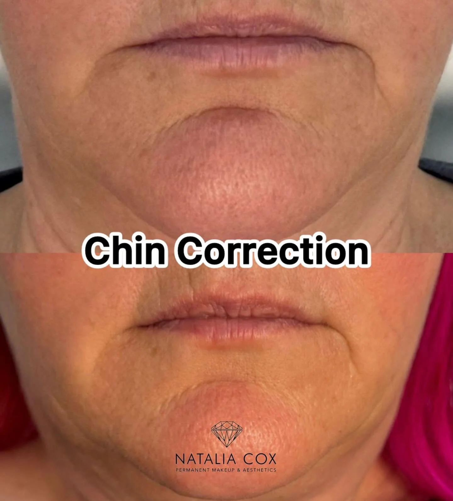 Tired of that &ldquo;dumpling chin&rdquo; look?

When the chin appears dimpled or uneven, it can make the lower face look tense or heavier than it really is. With the right approach, that texture can be softened for a smoother, more balanced look&mda