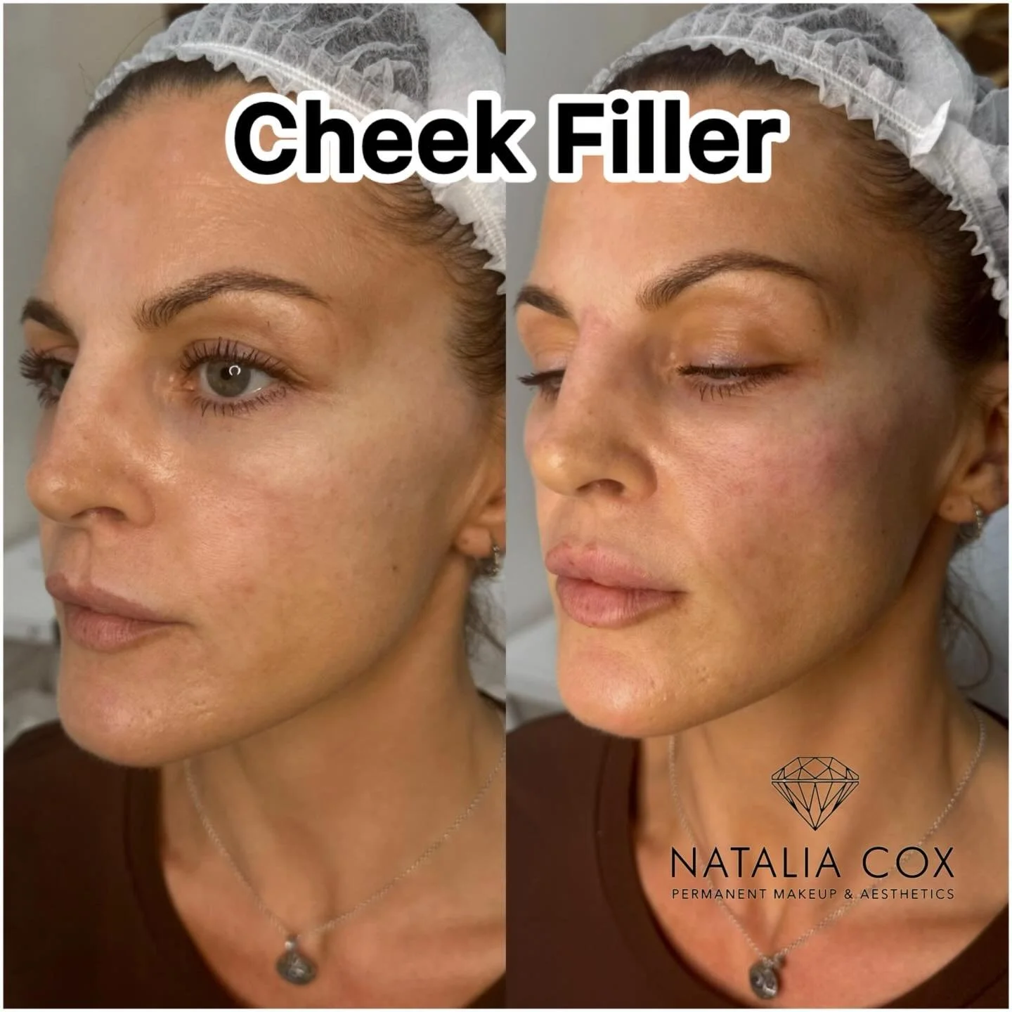 Cheek Sculpting: Magic or Science🪄

We often get asked: &ldquo;Will it be obvious that I&rsquo;ve had work done?&rdquo; Our answer is &mdash; only if you want it to be! Modern filler techniques allow us to achieve the most natural-looking results.

