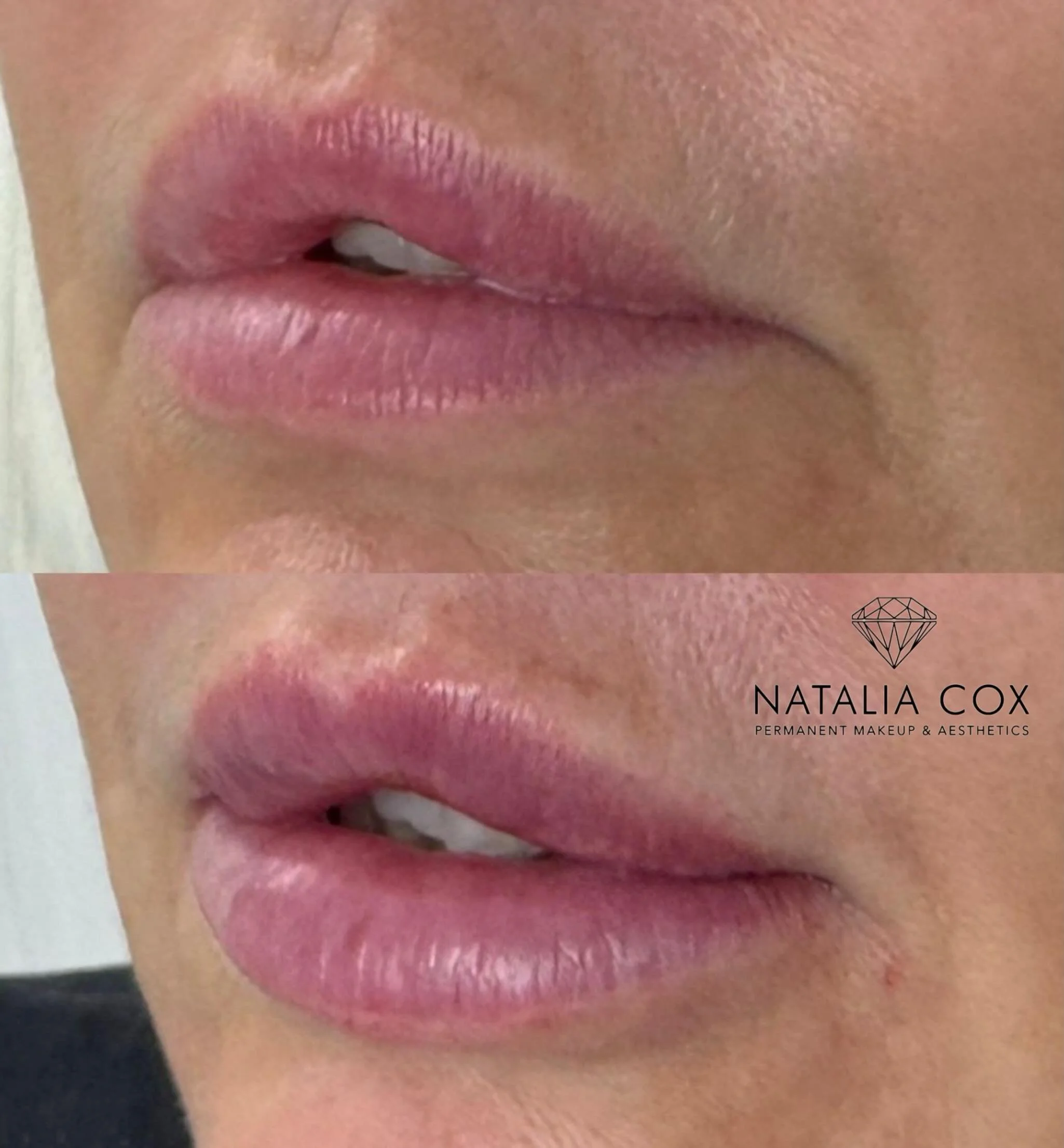 ✨ Lifted corners, fuller lips, softer expression ✨

This treatment was specially designed to correct drooping corners of the mouth &mdash; creating a more lifted, refreshed, and youthful appearance without looking overdone. 💋

By strategically placi