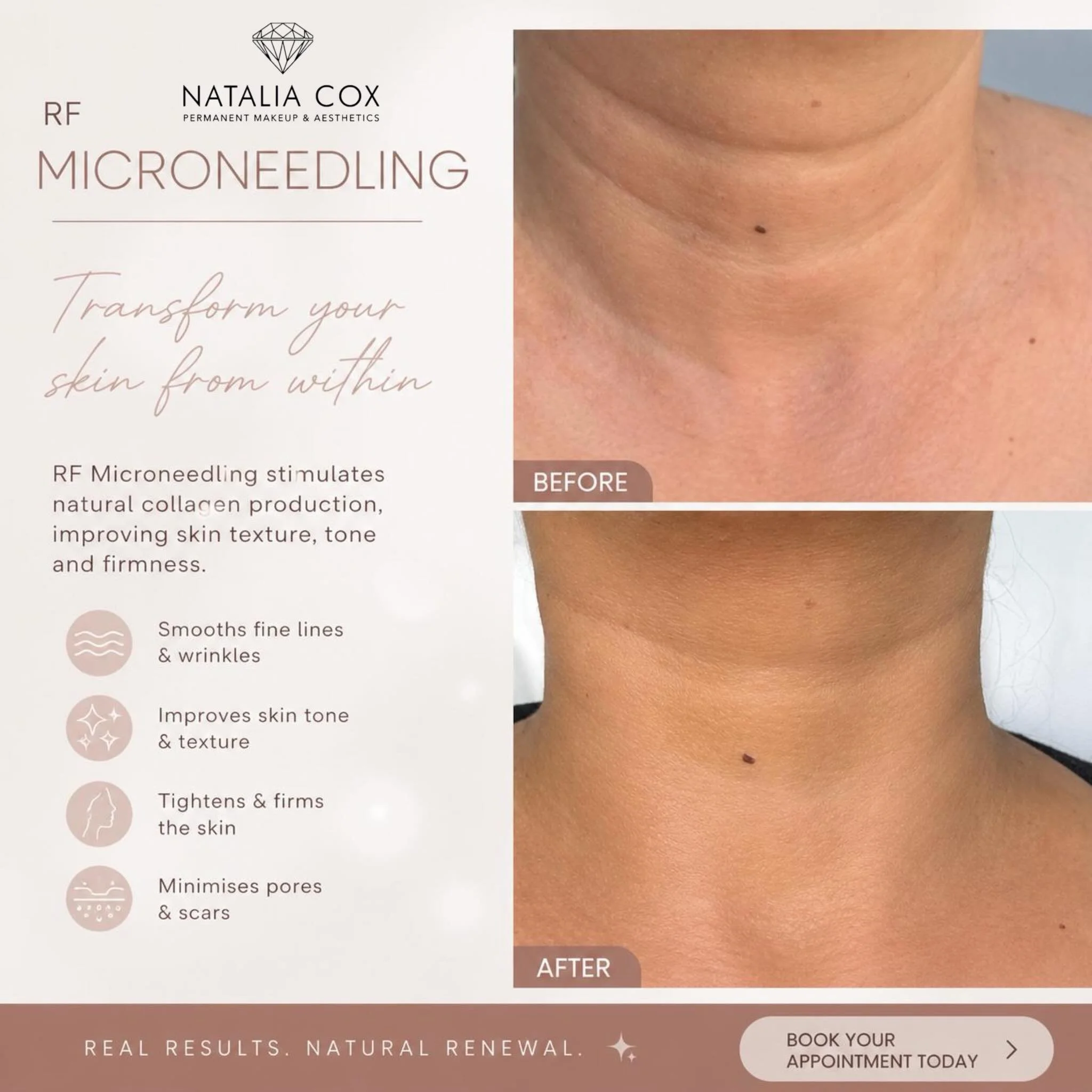 ✨RF Microneedling Neck Rejuvenation✨

A beautiful improvement in skin texture, firmness, and fine lines after RF Microneedling treatment.

RF Microneedling combines collagen induction with radiofrequency energy to help tighten, smooth, and rejuvenate