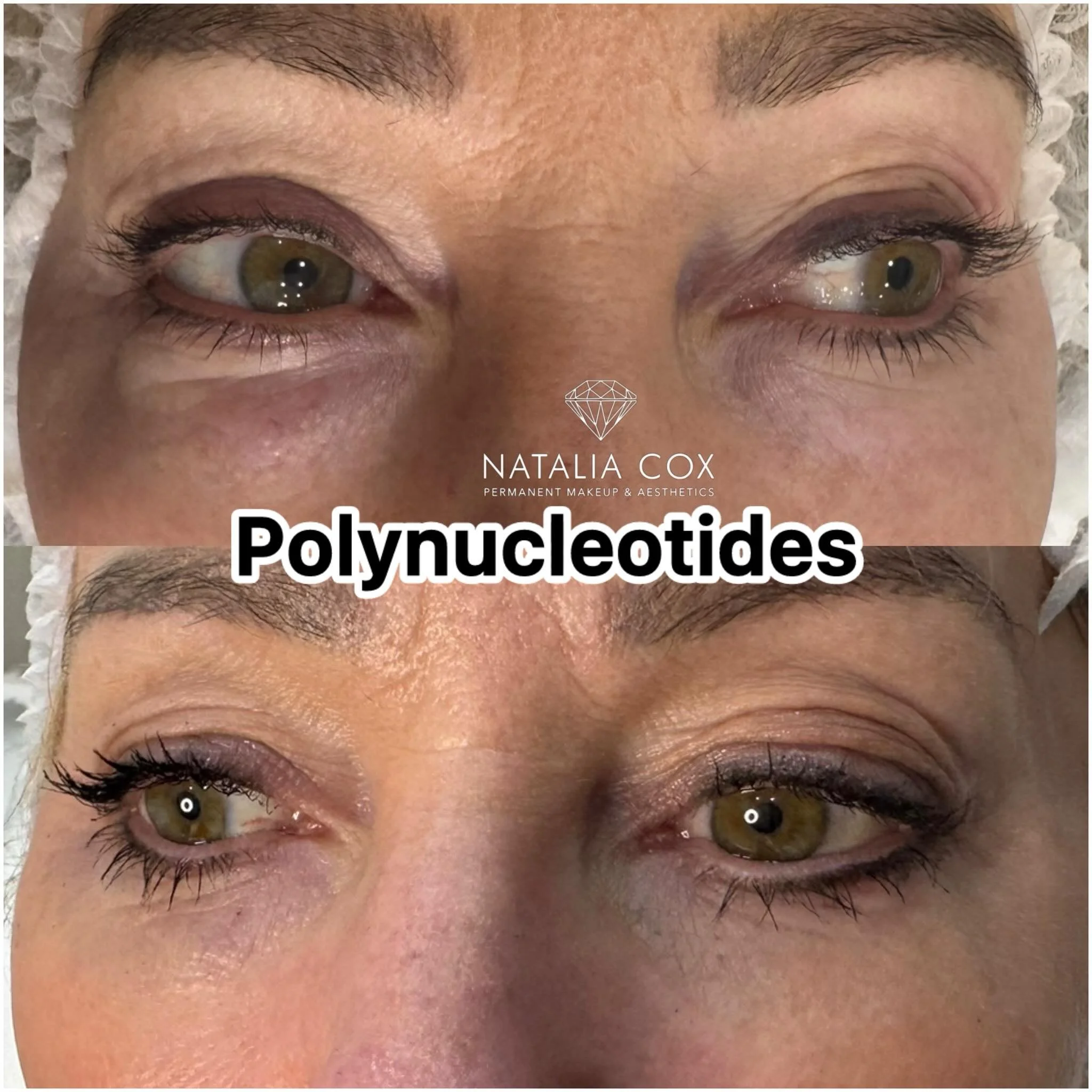 ✨ Polynucleotides: The Ultimate Under-Eye Regeneration Treatment ✨

Tired-looking eyes, crepey skin, fine lines, and dark circles? Polynucleotides work by stimulating your skin&rsquo;s natural repair process, improving hydration, elasticity, and over