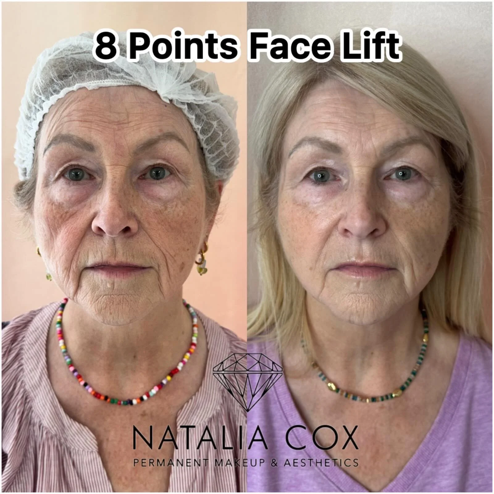 ✨ 8-Point Facelift Transformation ✨

A subtle lift can make a powerful difference.

Swipe to see this beautiful before &amp; after following an 8-Point Facelift treatment. 💉

✔️ Restored mid-face volume
✔️ Lifted cheeks and softened nasolabial folds