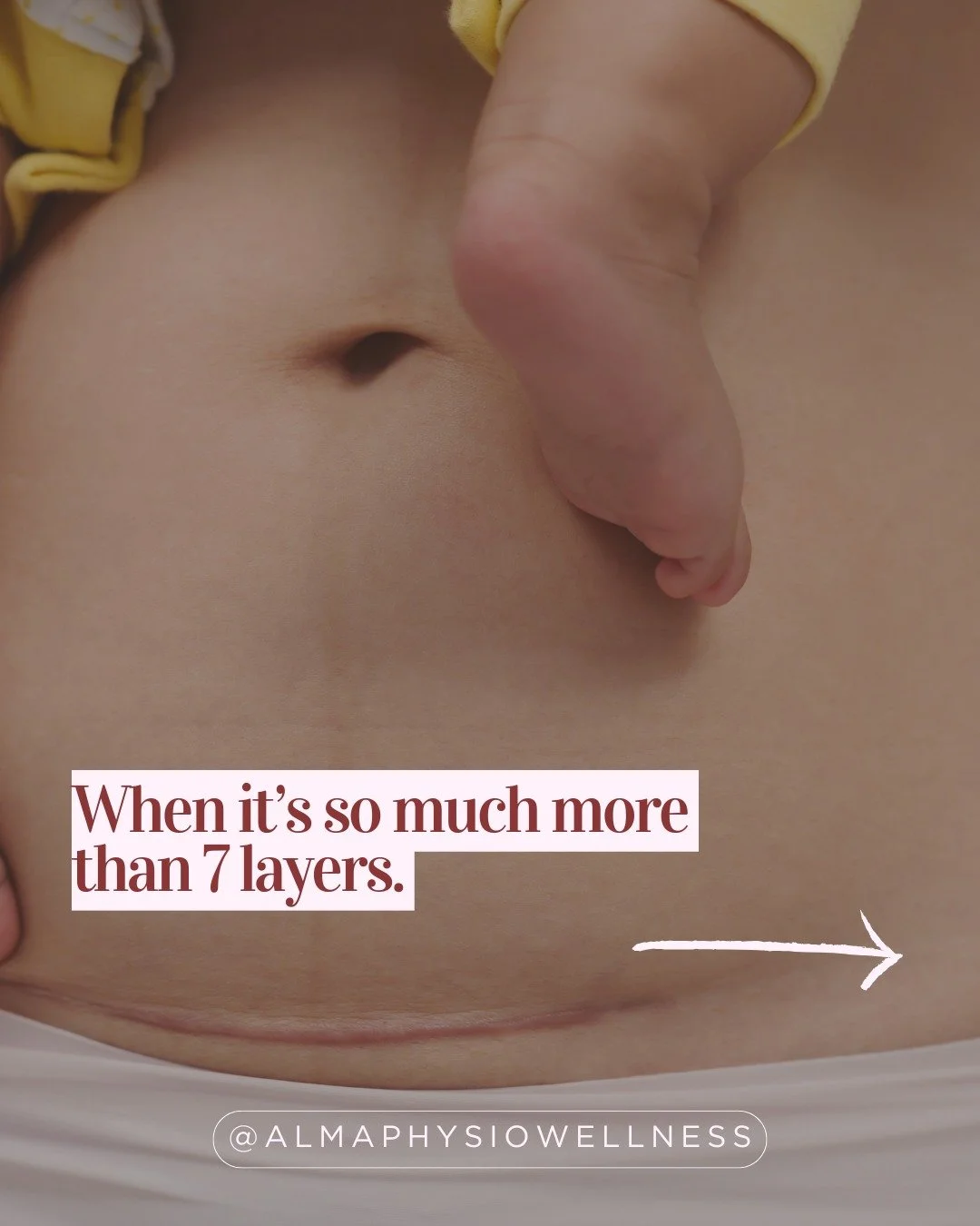 So much more than 7 layers.

Unfortunately postnatal care in the UK is still pretty terrible, and C-section post op care is even worse, even though abdominal birth rates continue to rise. 

At Alma, all our postnatal specialists (scar therapists and 