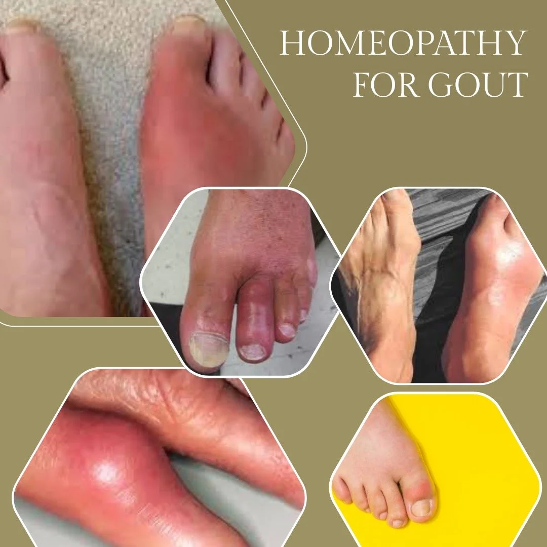 Gout is a type of inflammatory arthritis caused by a buildup of uric acid in the blood. When uric acid levels get too high, sharp urate crystals can form in the joints, most commonly the big toe but can be any joint, leading to sudden, intense pain.
