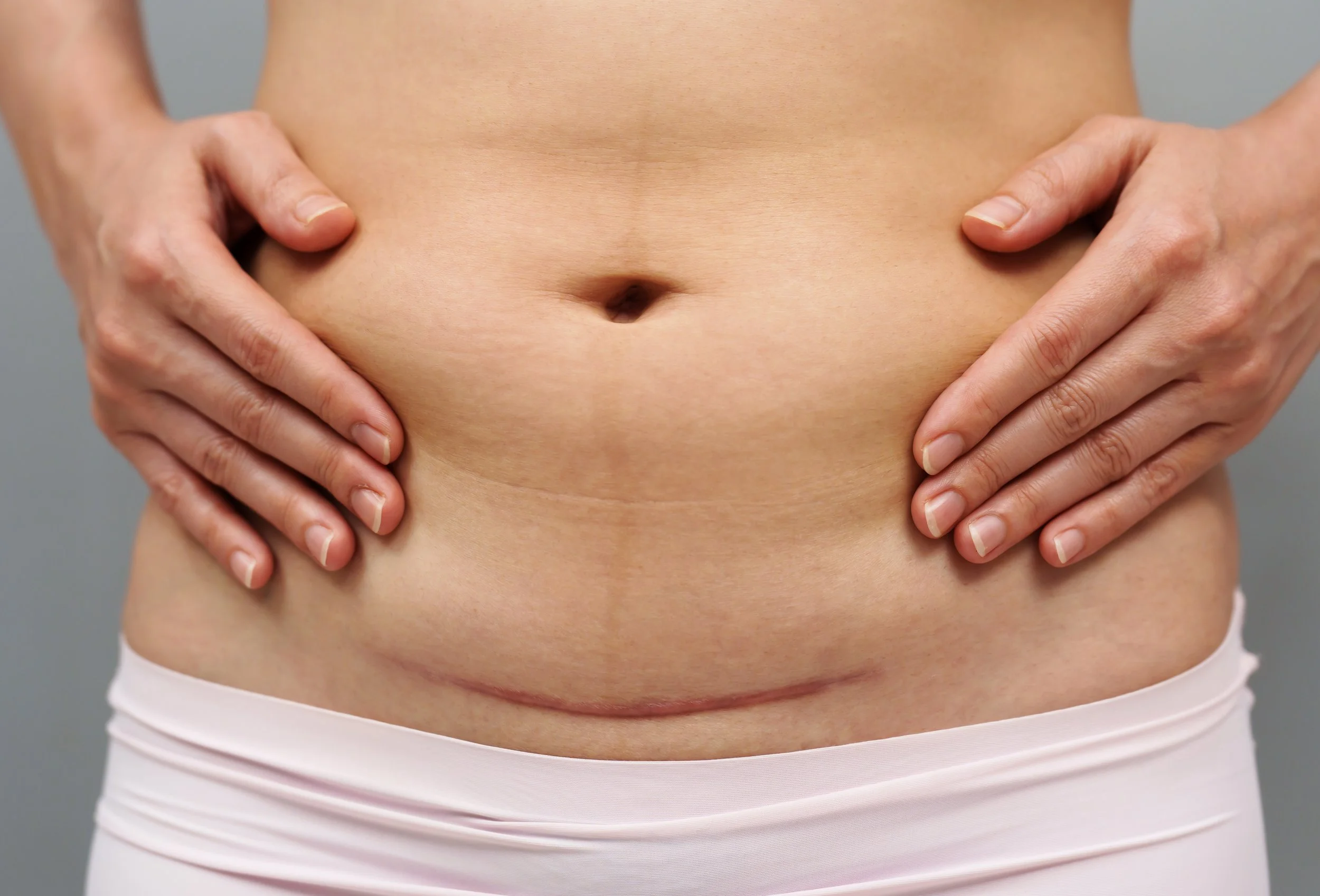 Preparing for a Planned C-Section: How to Support Healing Before Surgery