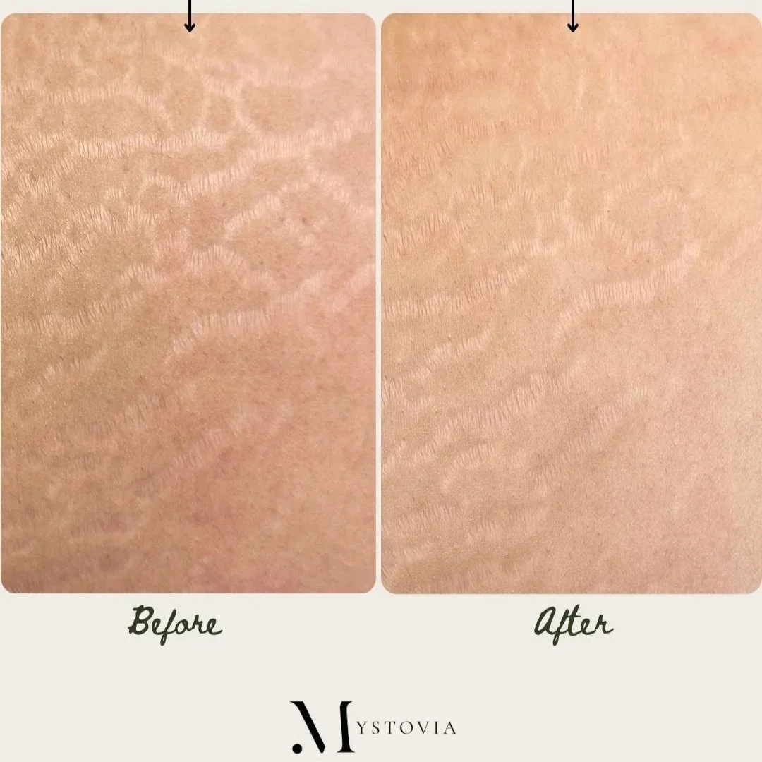Beige+Minimalist+Beauty+Skincare+Before+After+Collage+Instagram+Post+%28Your+Story%29+%281%29.jpg