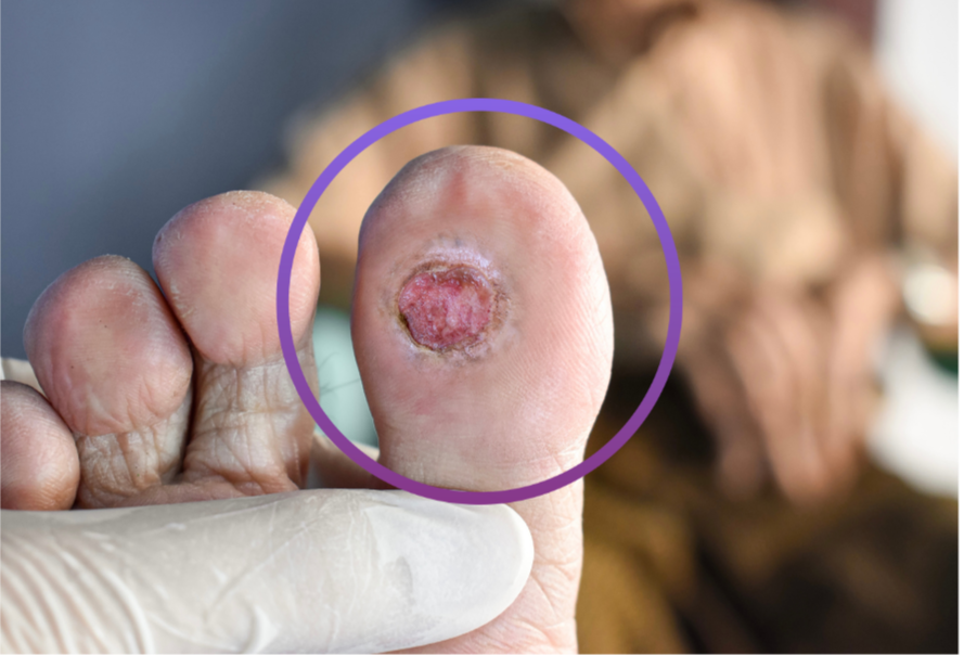 Close-up of a person's toe with chronic DFU
