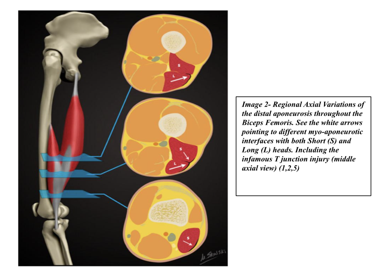 Aponeurotic hamstring structure