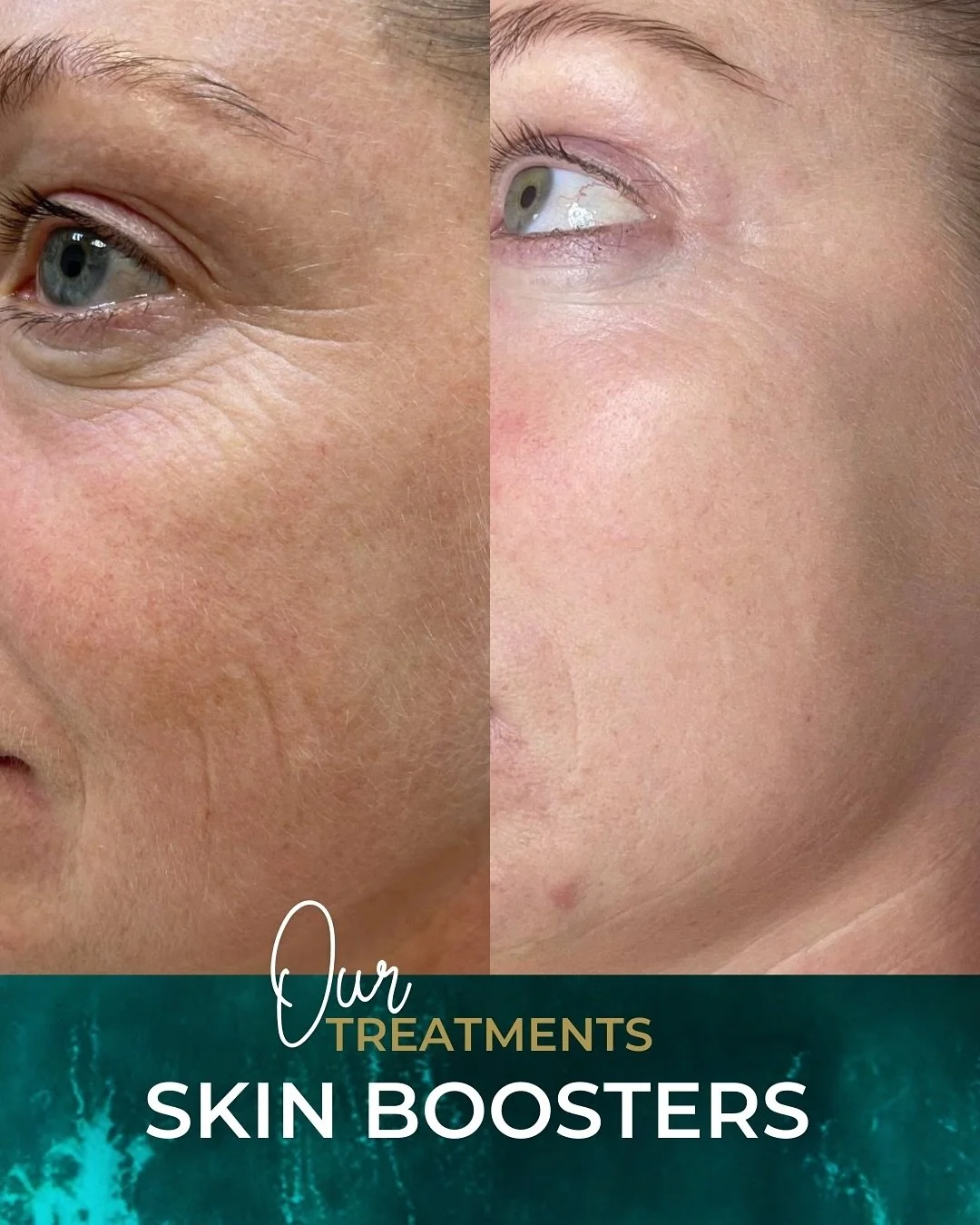 Skin boosters are a great option if your skin is feeling dull, dehydrated or in need of a refresh. They aren&rsquo;t filler and don&rsquo;t change your face shape, instead they work beneath the surface to improve skin quality over time.

✨ Offer - 10