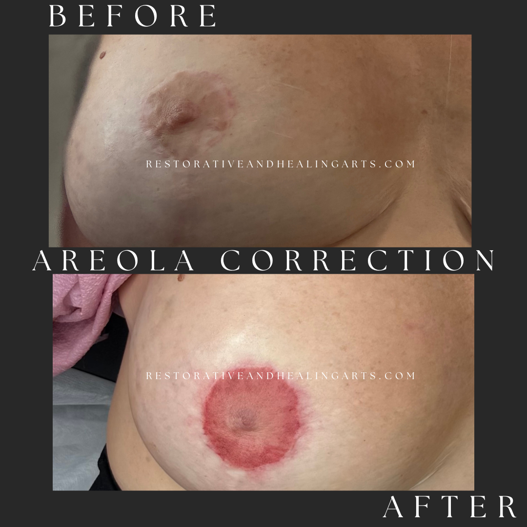 Areola Correction (2).png