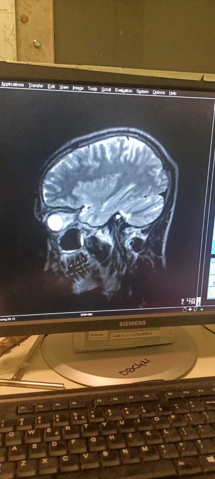 First brain MRI image from the newly installed Siemens MAGNETOM C