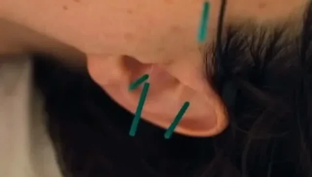 Ear Seeds for Anxiety: How This Ancient Technique Is Helping San Franciscans Find Calm