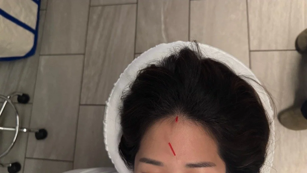 Top view of a woman with dark hair and facial marking lines on the forehead during a cosmetic or skincare treatment session