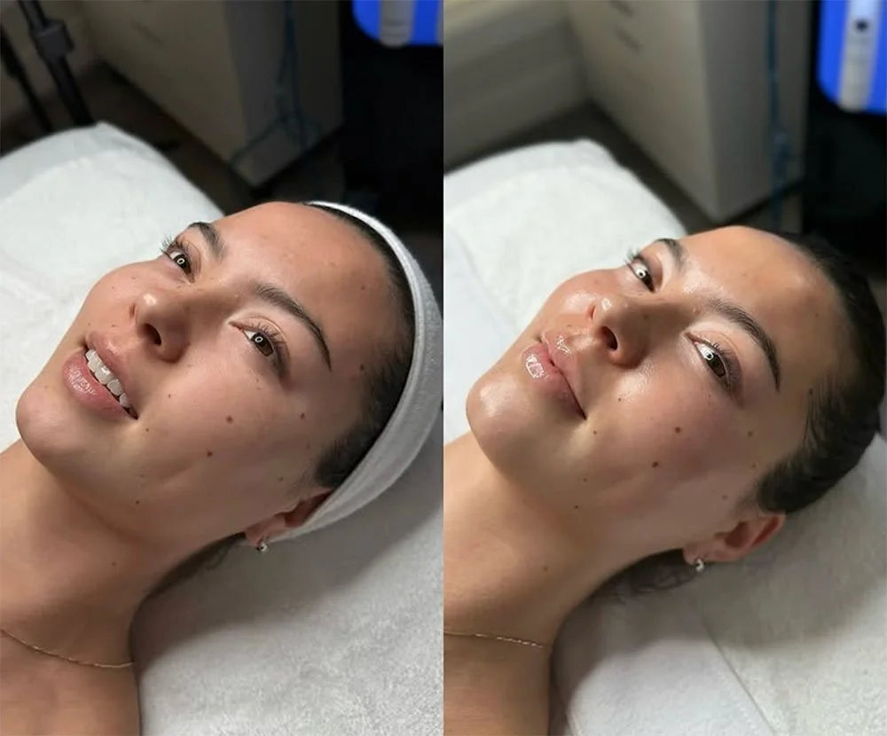 Before and after HydraFacial treatment on young woman showing brighter, clearer skin at The Ivy Day Spa.