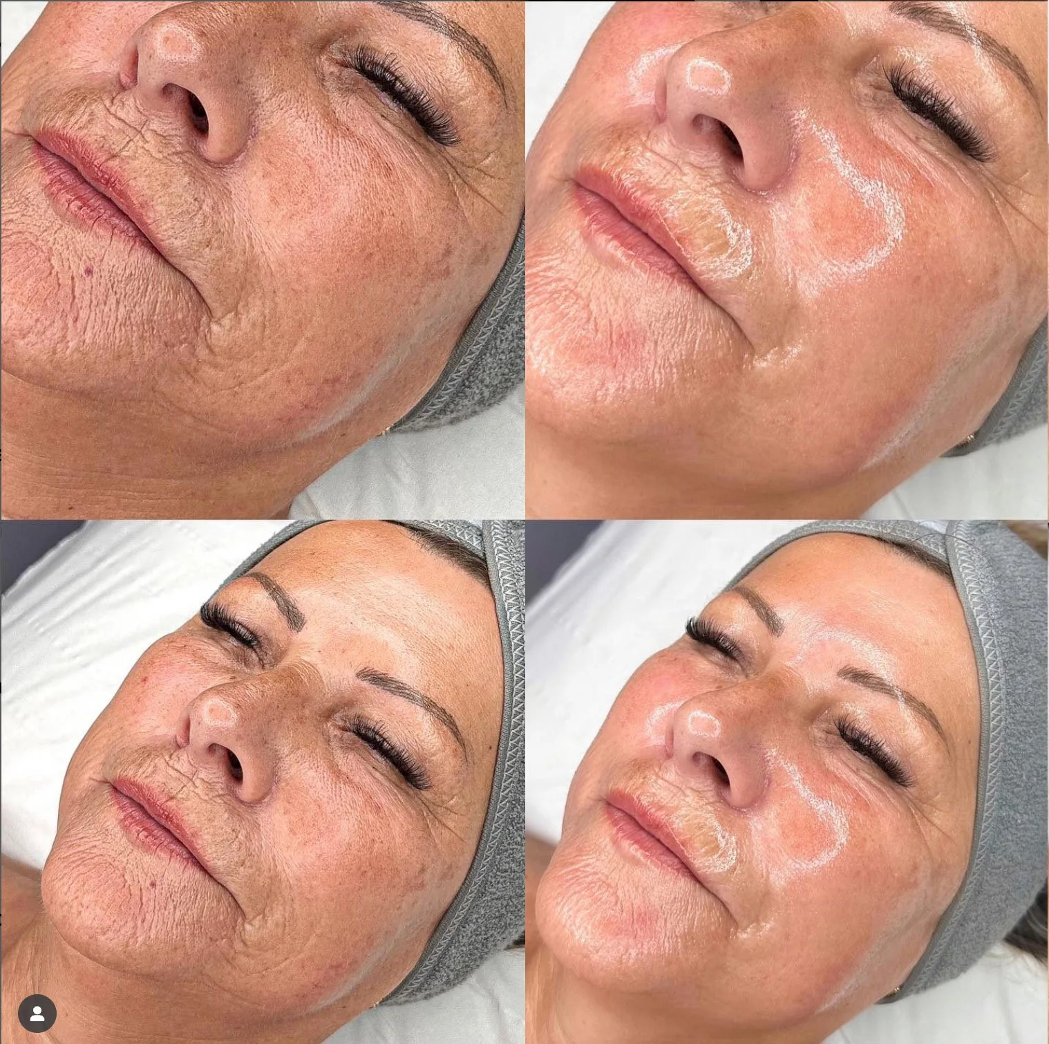 hydrafacial-BA2.jpg