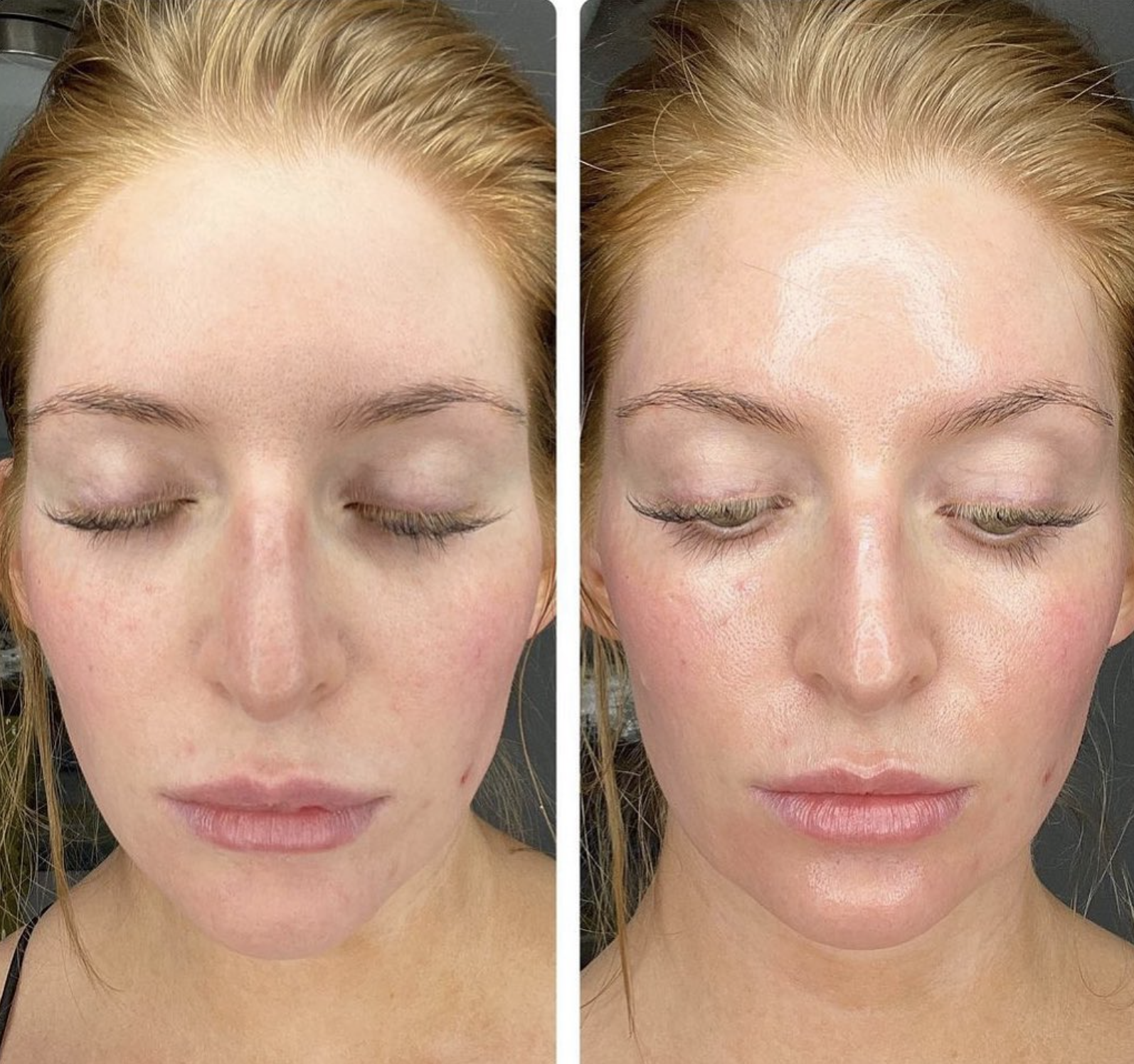 Before and after HydraFacial treatment results at The Ivy Day Spa in Santa Clarita showing clearer, smoother skin.