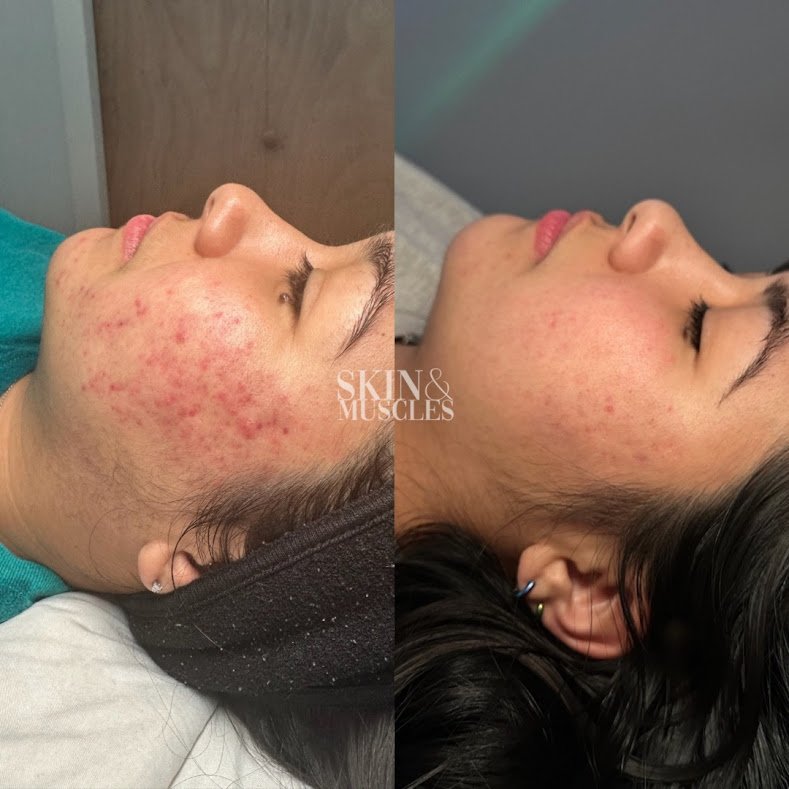 Acne Treatment