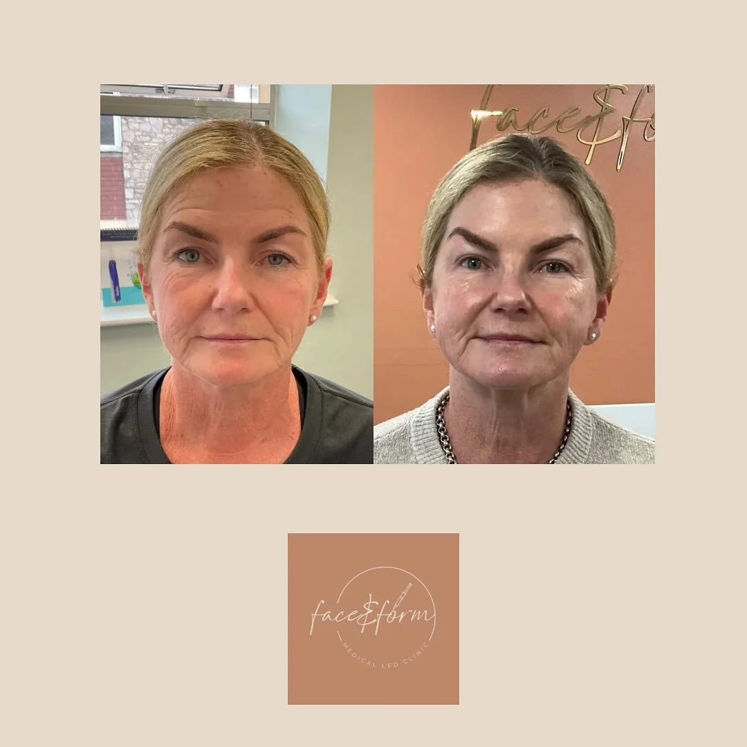 ⬆️THIS 💕

This is what I do. Full face harmonisation to help you feel like you again. Still looking natural, just refreshed 💦 

As always- this wasn&rsquo;t achieved in one session, this first photo was taken in July and the second this week.

Woul