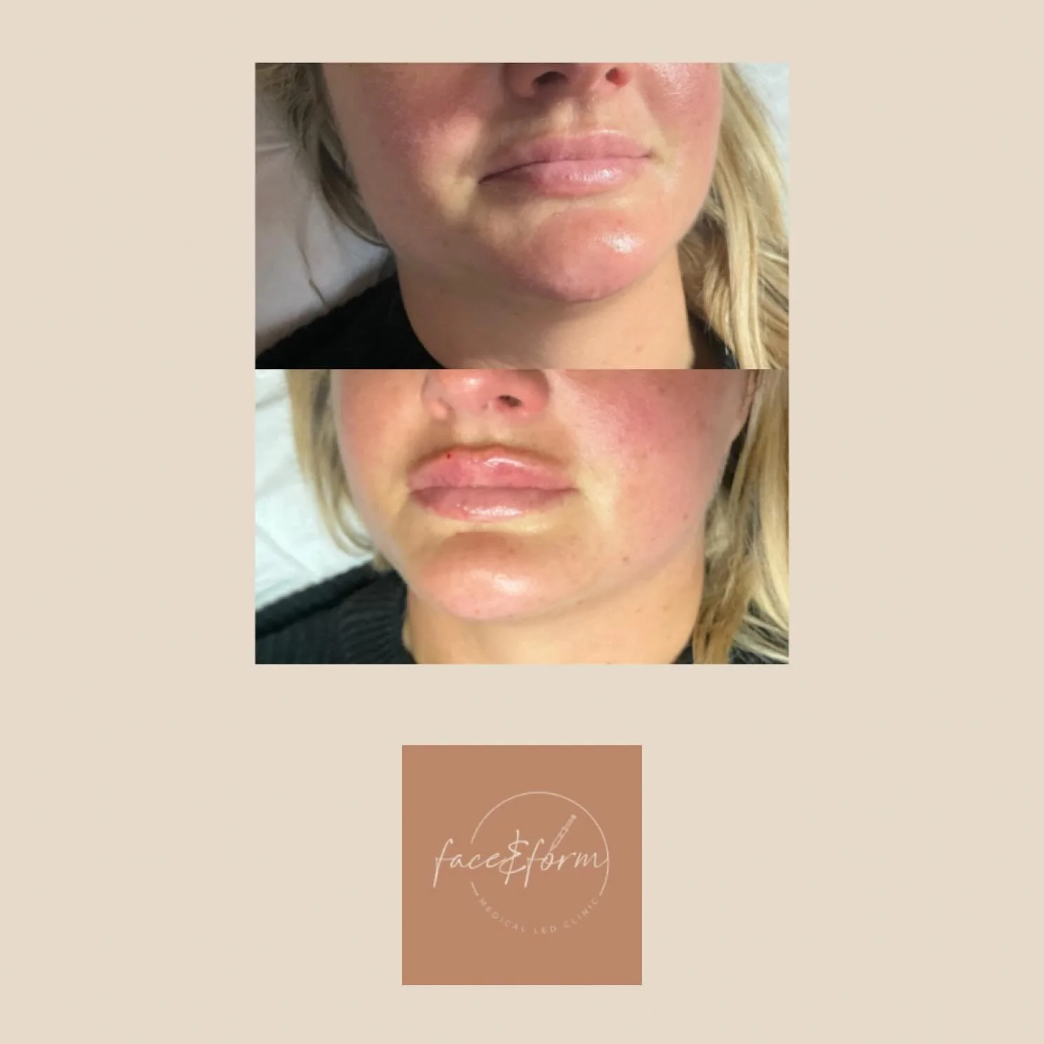✨ Lip Filler Glow-Up ✨

Subtle, smooth, and perfectly you 💋 Lip filler isn&rsquo;t about changing who you are&mdash;it&rsquo;s about enhancing what you already have. A little volume, improved shape, and that hydrated, pillowy finish ✨

Results are c