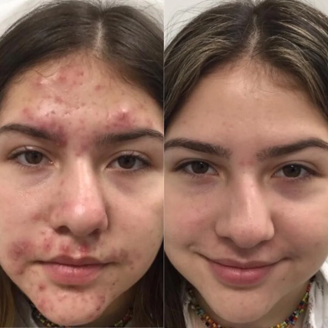 Acne. Corrective acne care, professional treatments, and personalized home care.