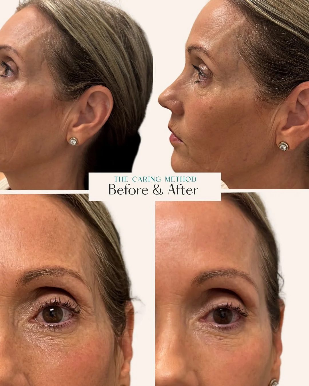 Temple filler restores natural contour and volume to the upper face, helping soften a hollowed or sunken look that can happen with age or weight loss. By adding subtle lift to the temples, this treatment creates a smoother, more balanced facial shape