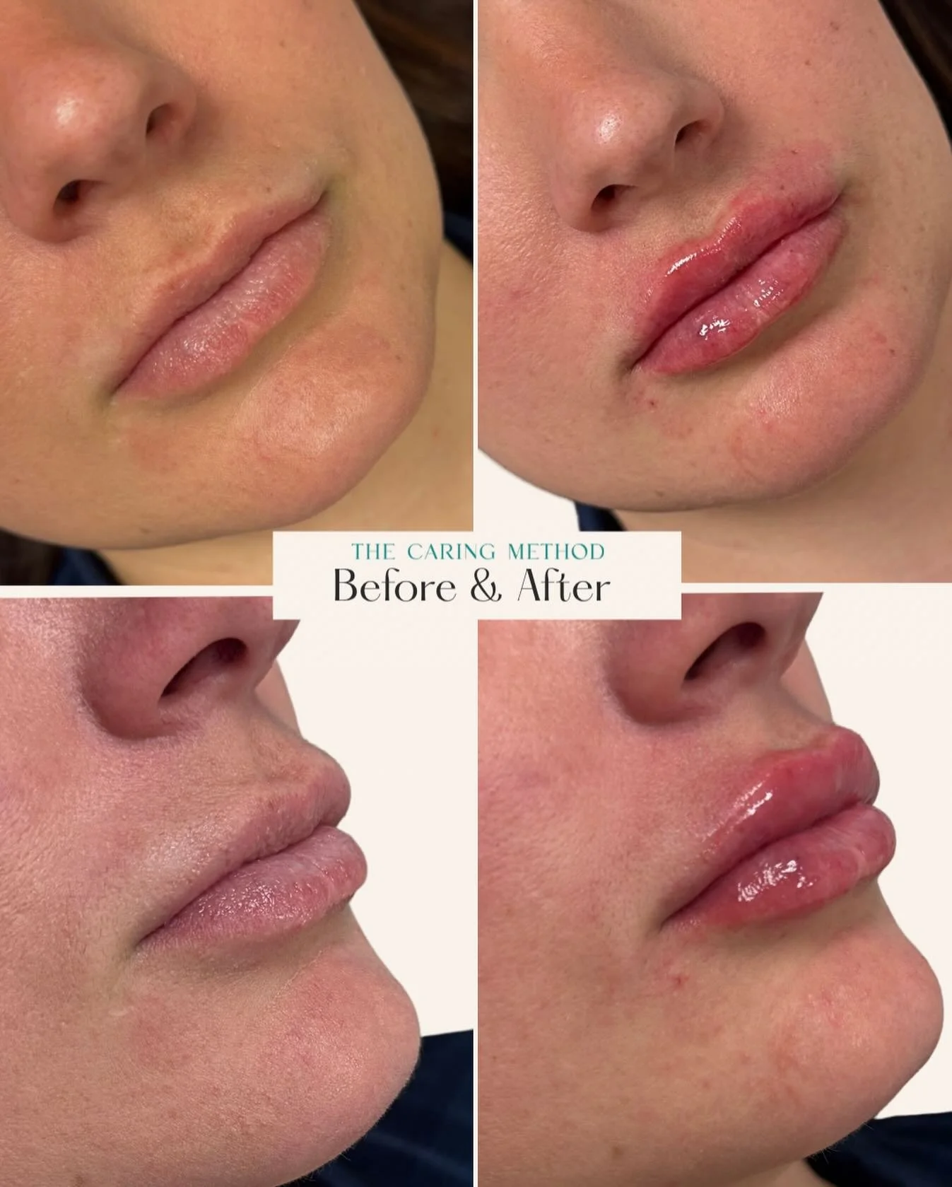 💋 Lip filler is an art &mdash; not a copy &amp; paste treatment.

It starts with listening.
What you love. What you don&rsquo;t. What you&rsquo;re hoping for&hellip; and what your anatomy will realistically allow.

Before a single drop of filler, I&
