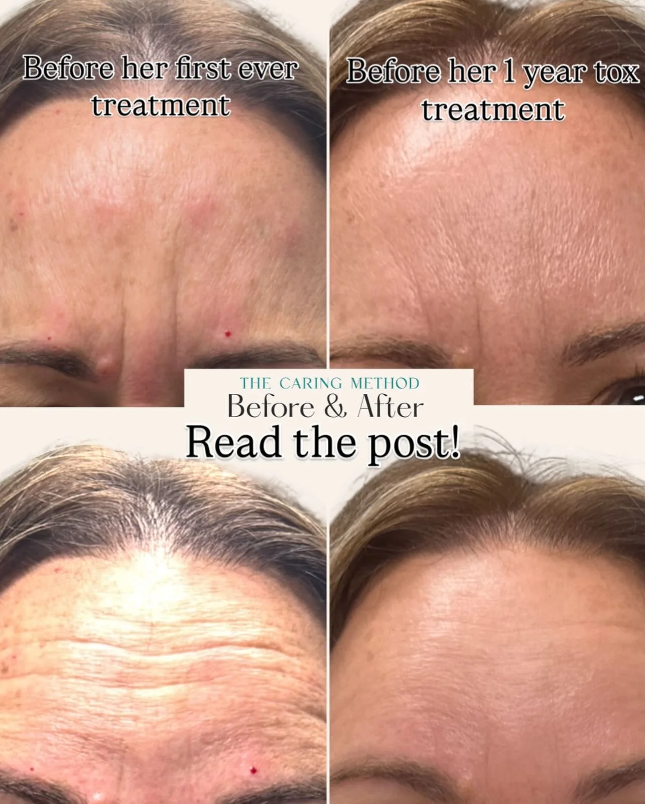 ✨ Consistency > one-and-done ✨

This is what a full year of consistent neuromodulator treatment can do.
Tox every 3&ndash;4 months, plus microneedling to support skin quality and collagen = softened, rested, healthier-looking skin over time.

Impo