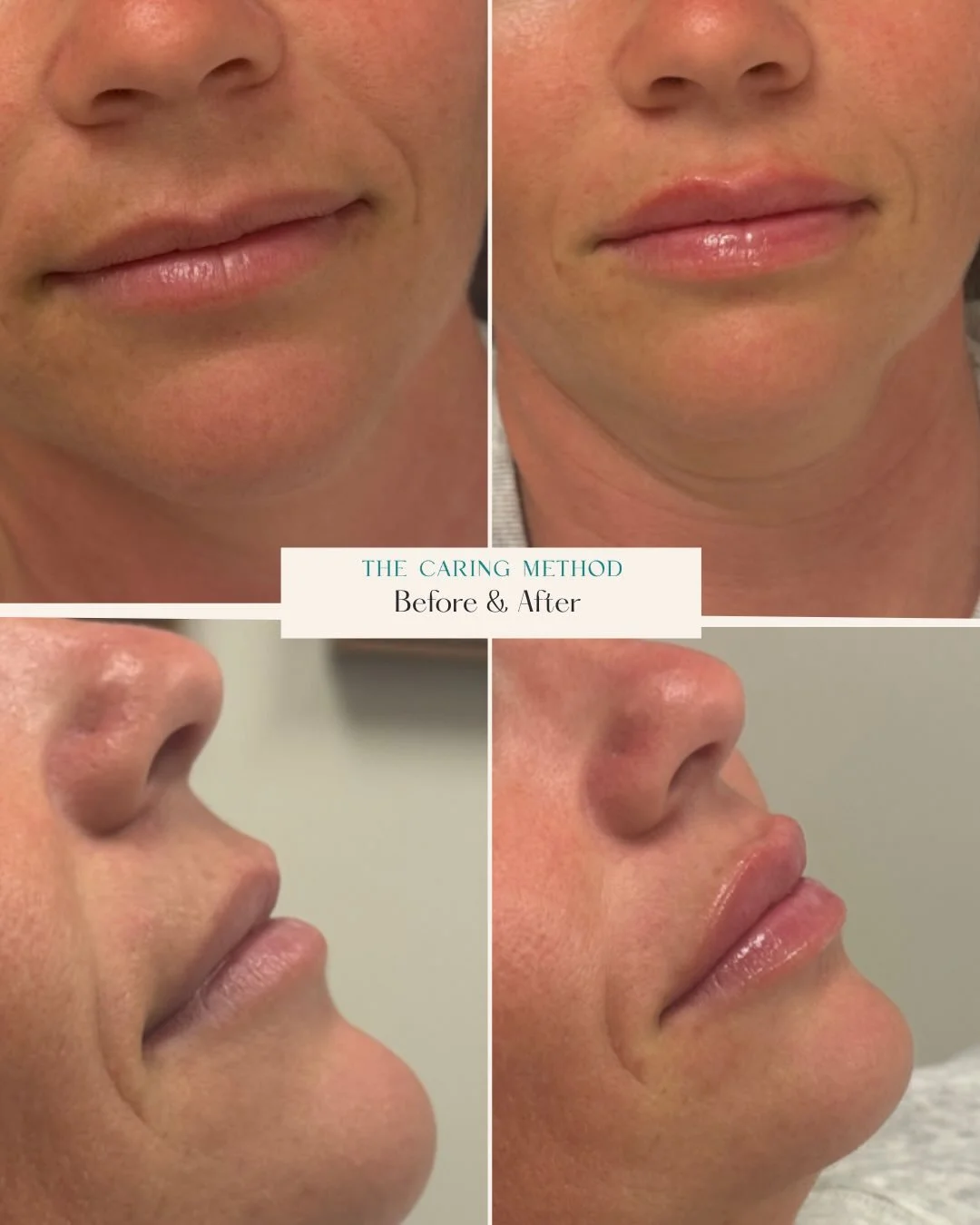 💋 Lip Filler Is an Art, Not a Template.

Every set of lips is different.
Every smile is different.
Every face deserves an individualized approach.

There is no &ldquo;one syringe fits all.&rdquo; There is no copy-and-paste technique.

As a nurse pra