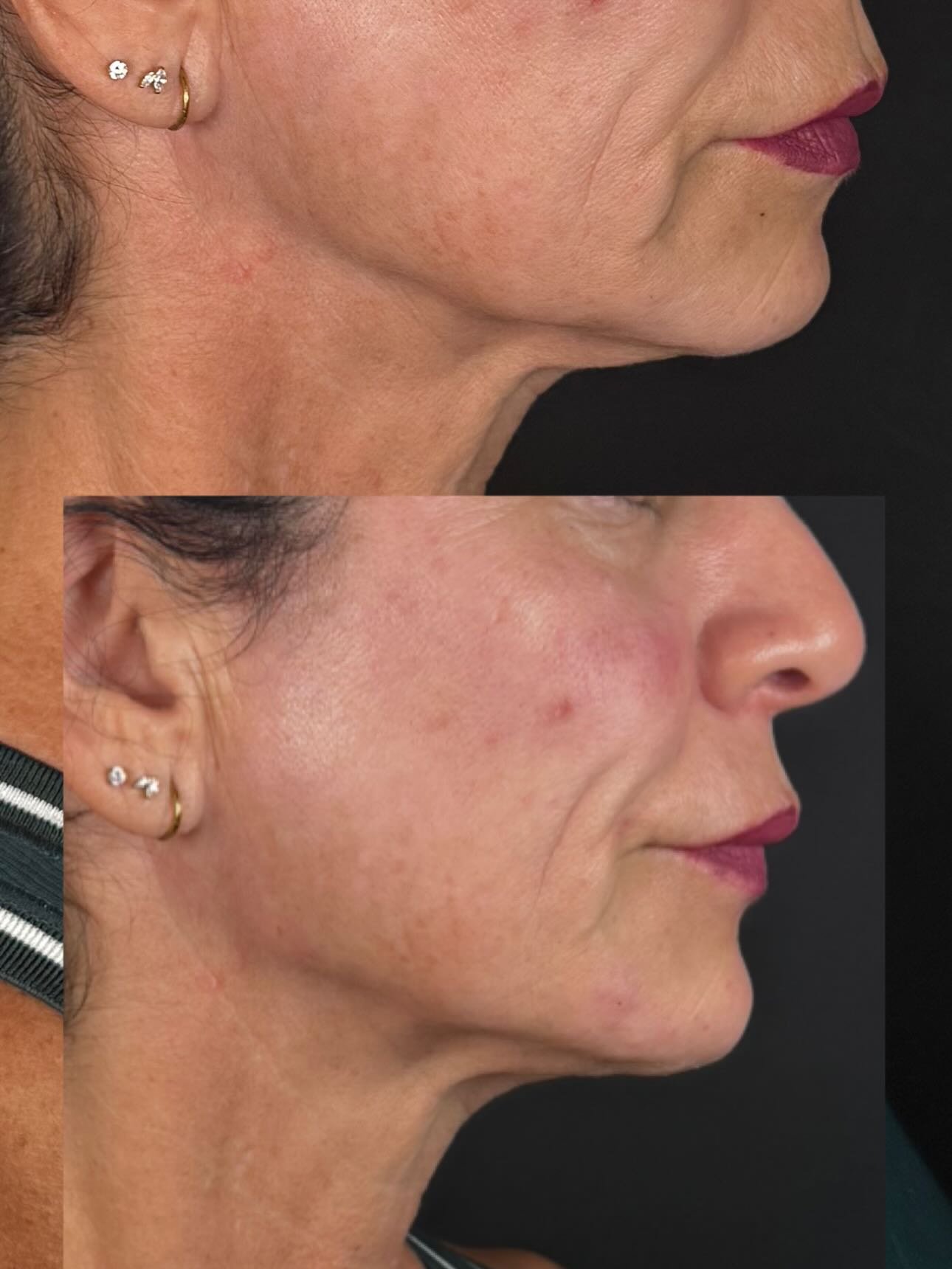 ✨ Subtle structure can make the biggest difference.

In these before and after photos, we used strategic dermal filler to restore structure and support in the midface and lower face. The goal wasn&rsquo;t to &ldquo;add volume,&rdquo; (outside of the 