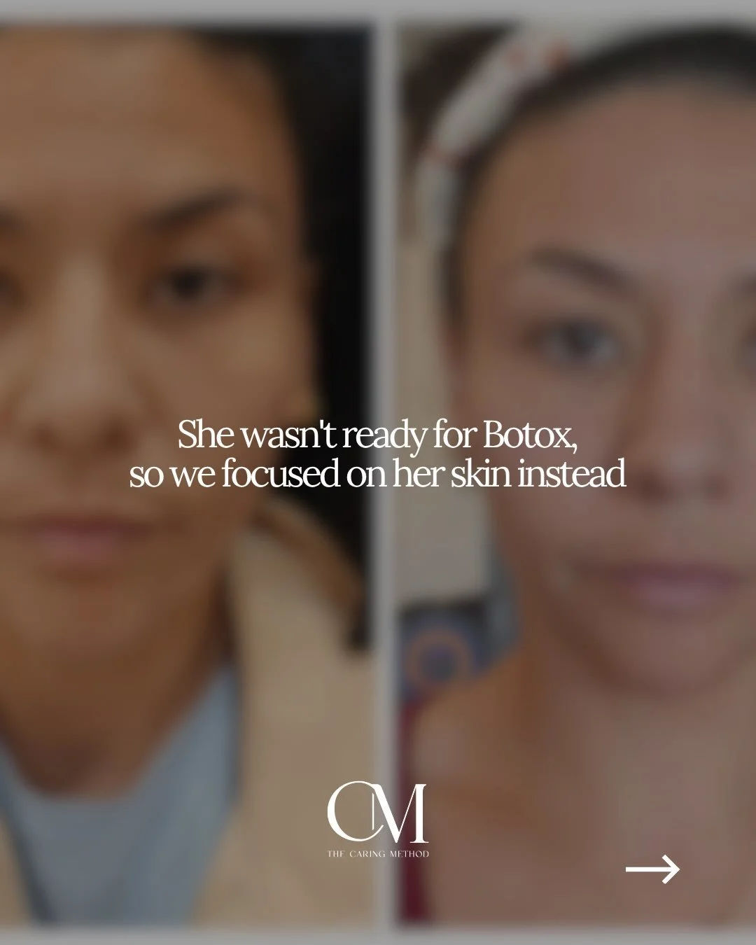 When she came in, her concern wasn&rsquo;t wrinkles. It wasn&rsquo;t volume loss.

She wanted brighter skin.
Less dullness.
More glow.
A healthier, refreshed appearance.

So instead of jumping straight to injectables, Shelby focused on skin quality.
