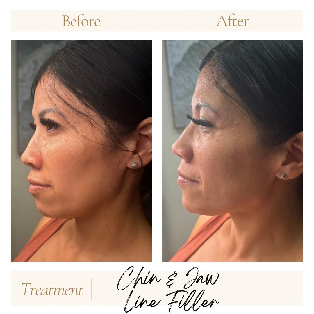 Before and after chin and jaw line filler