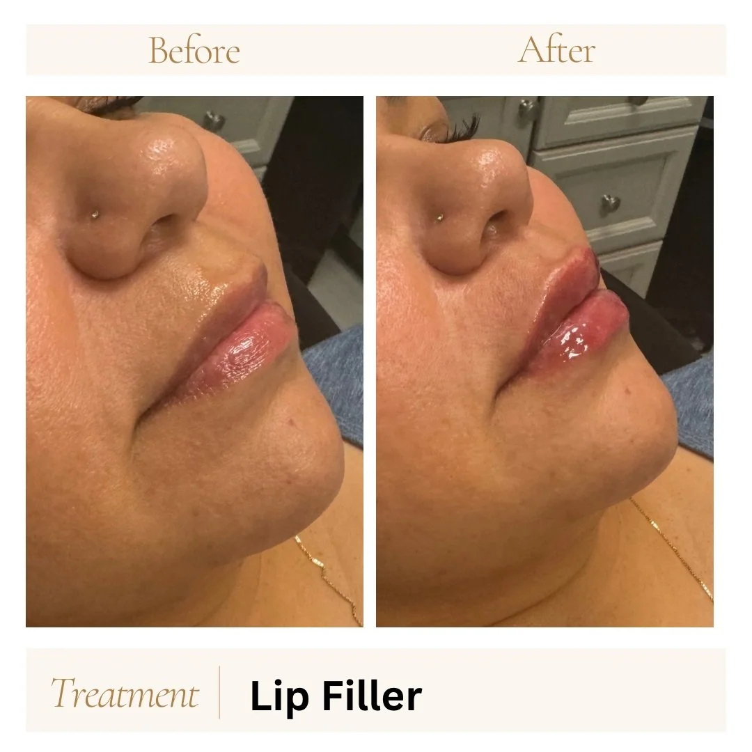 Before and after lip filler.