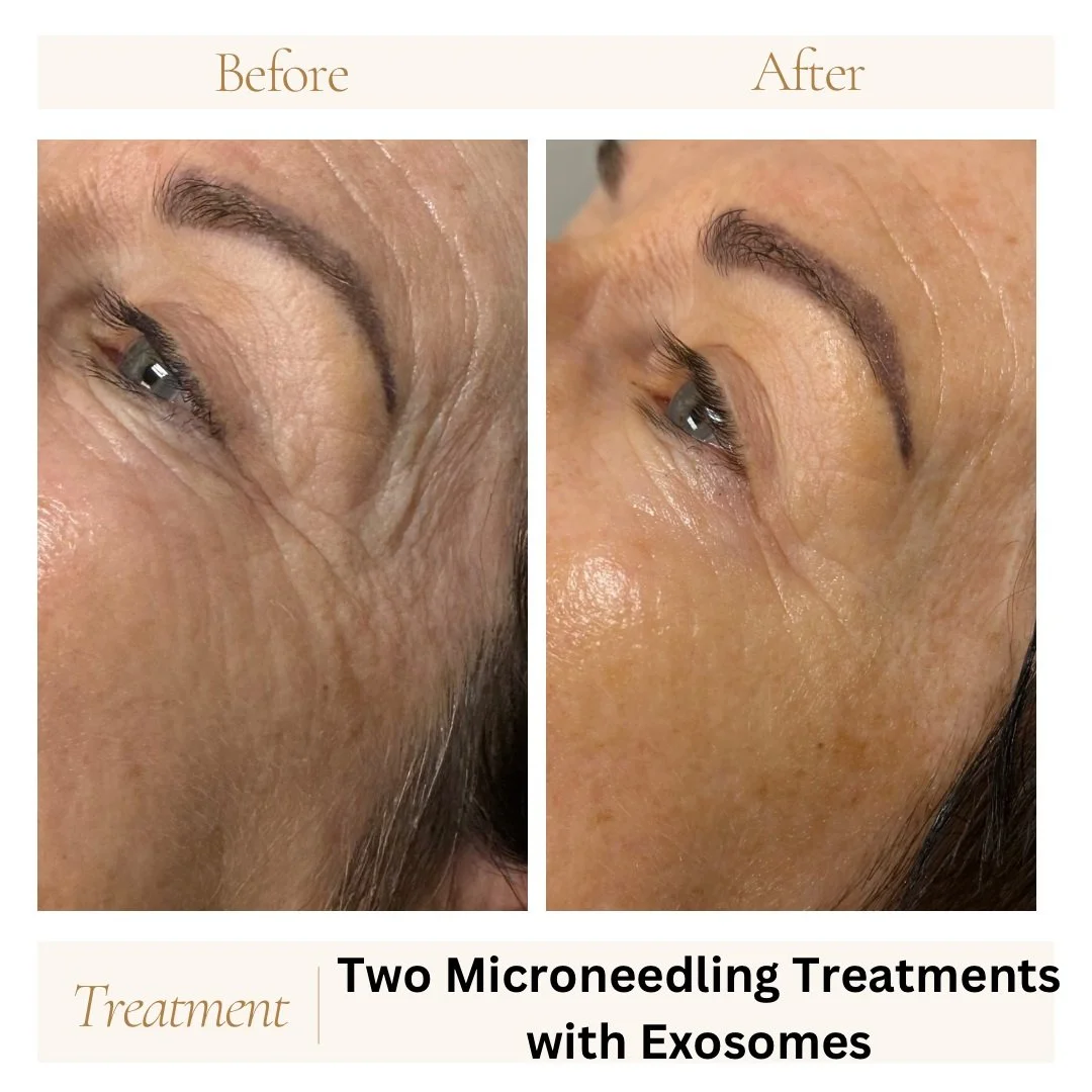 Before and after microneedling with two treatments with exosomes.