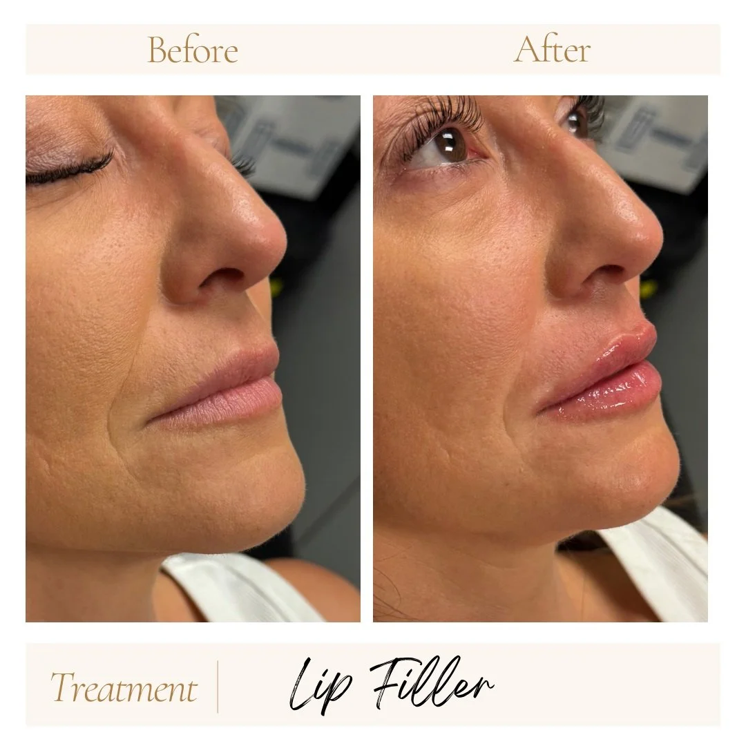 Before and after lip filler