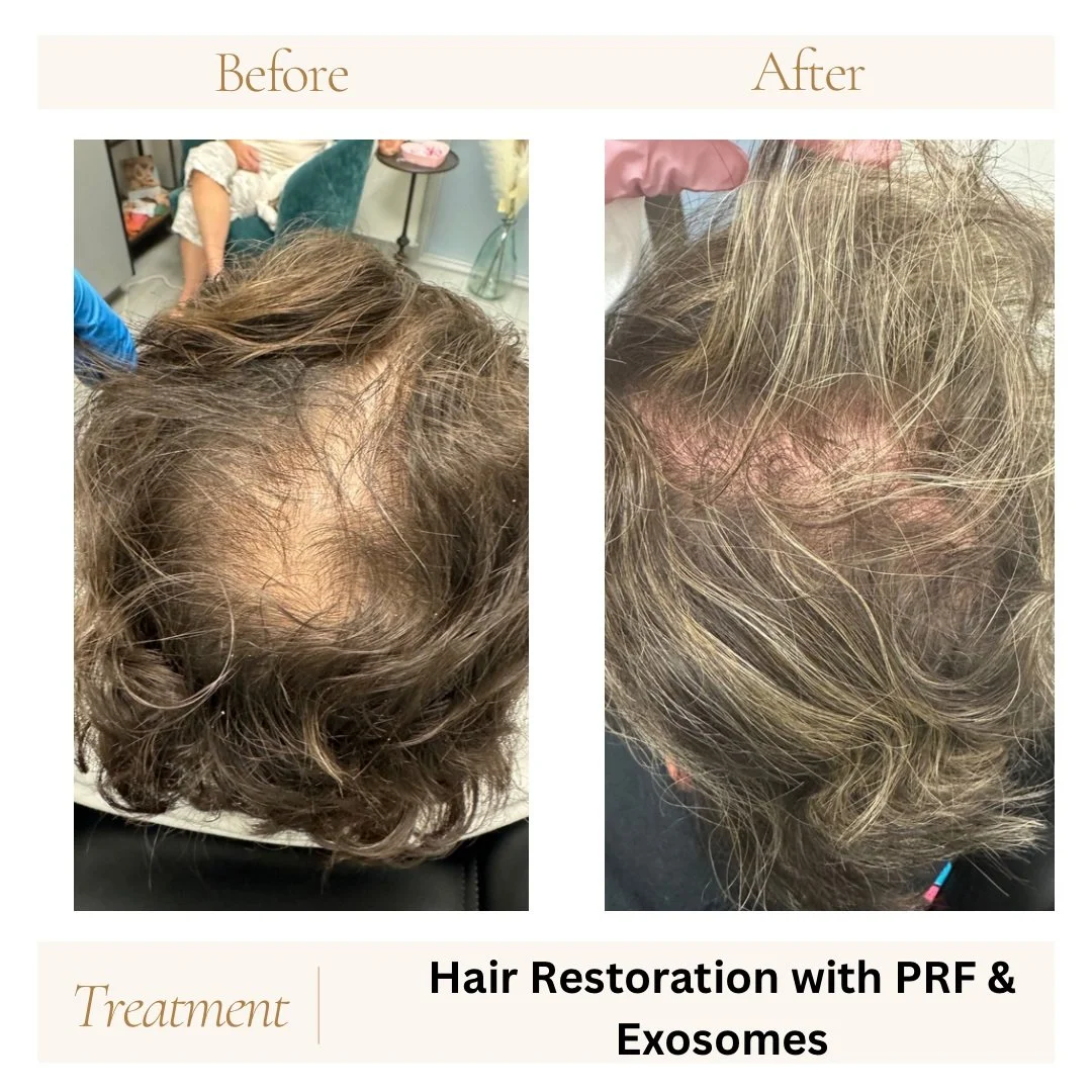 Before and after hair restoration with prf and exosomes.