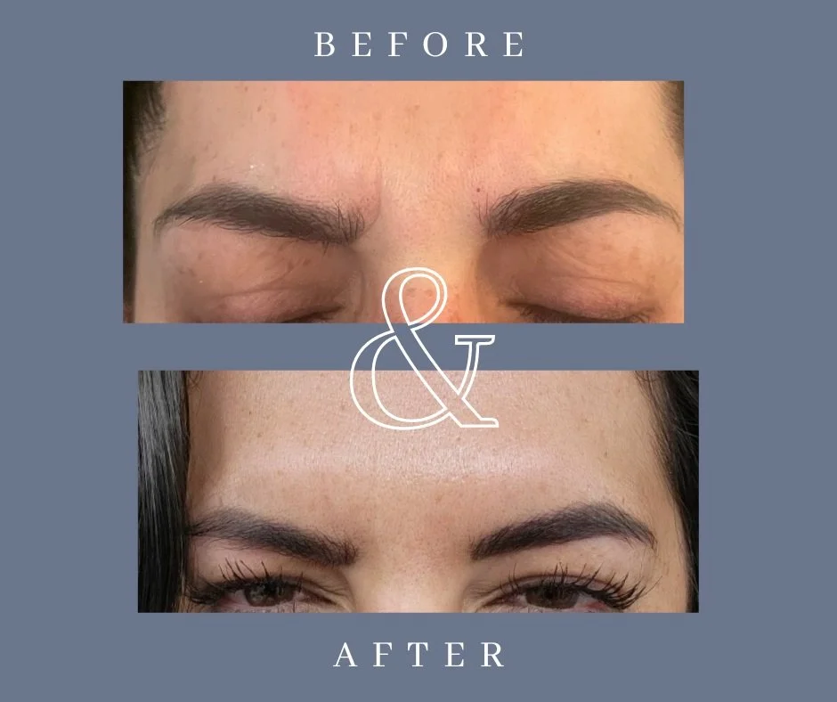 before and after wrinkle relaxer on forehead.