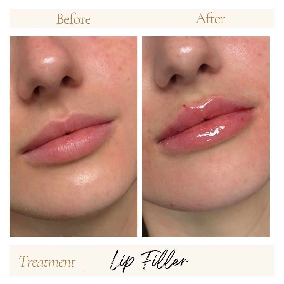 Before and after lip filler in Peoria, AZ.