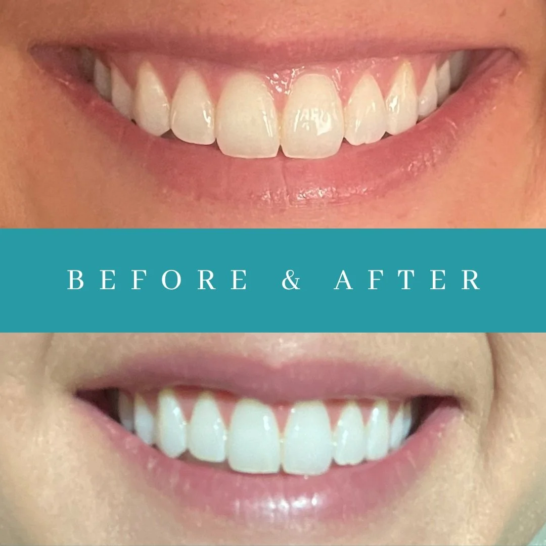 Before and after of smile for teeth whitening.