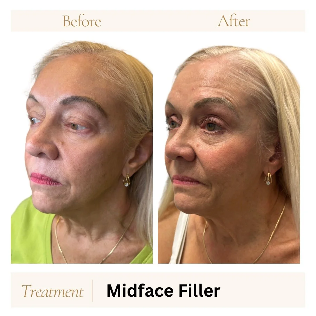 Before and after dermal filler on midface.