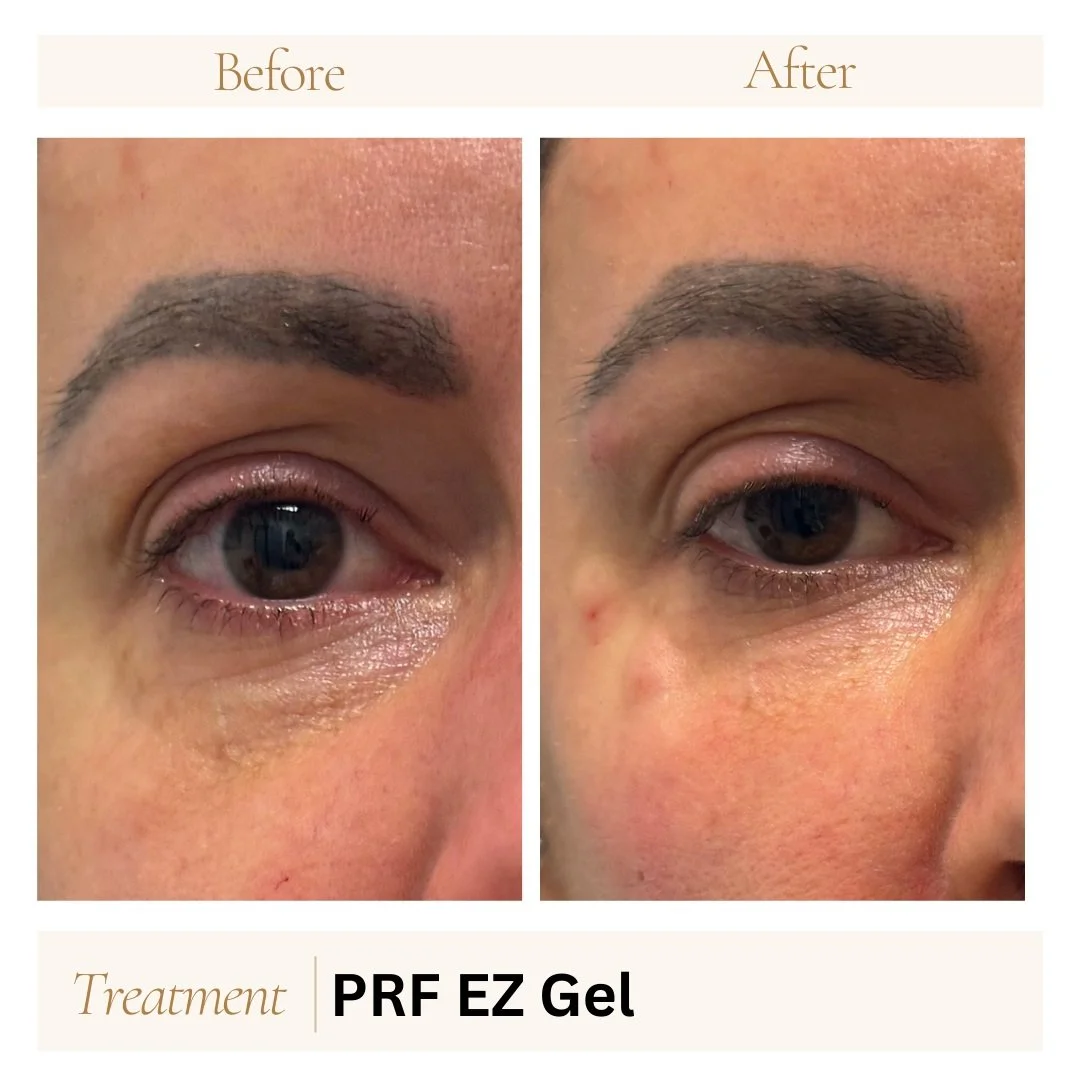 Before and after prf ez gel close-up