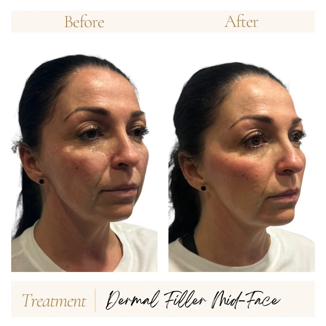 Before and after dermal filler mid-face.