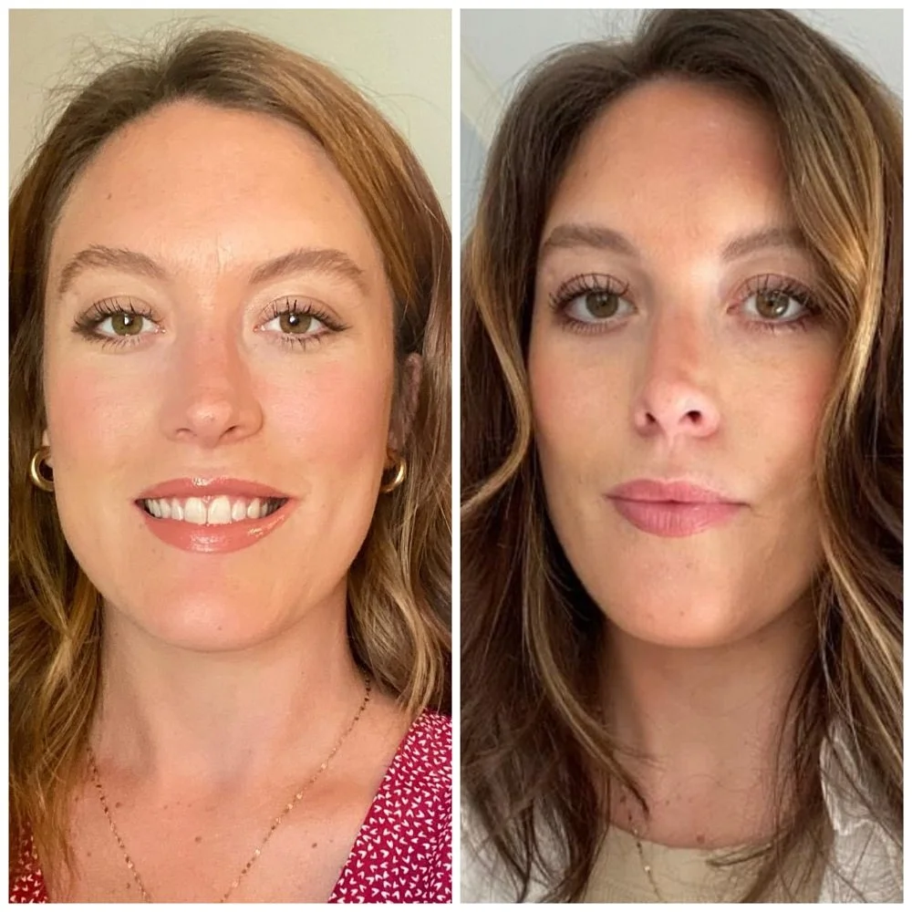 Before and after botox