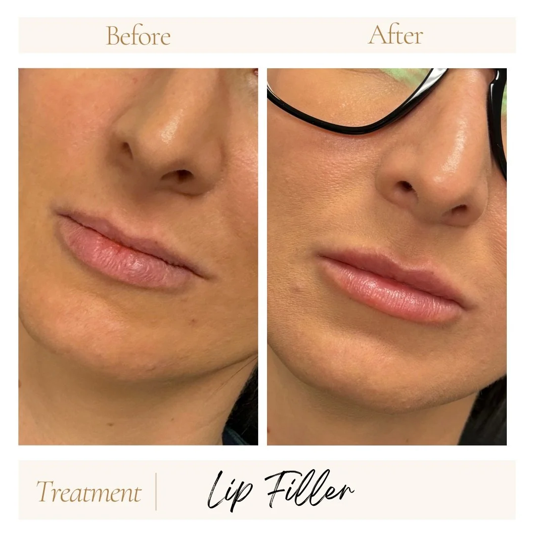 Before and after lip filler